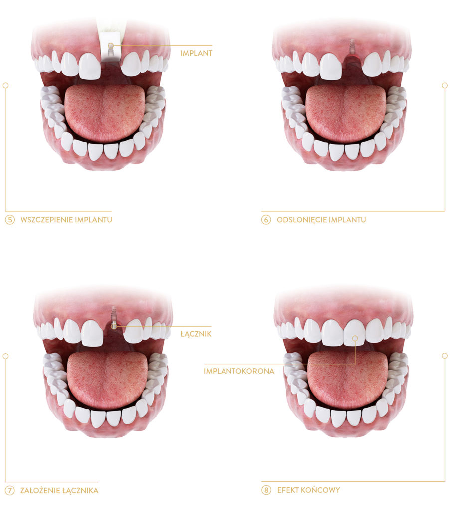 implanty zębów kraków
