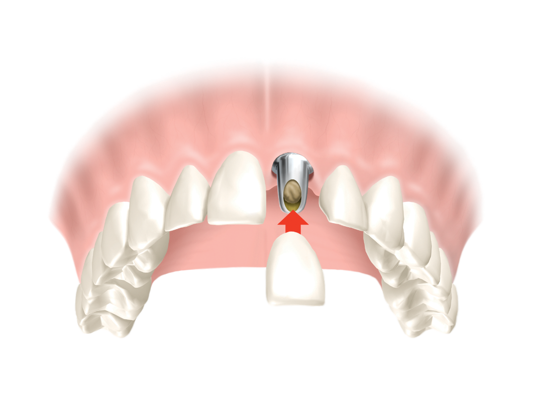 implant-supported crown