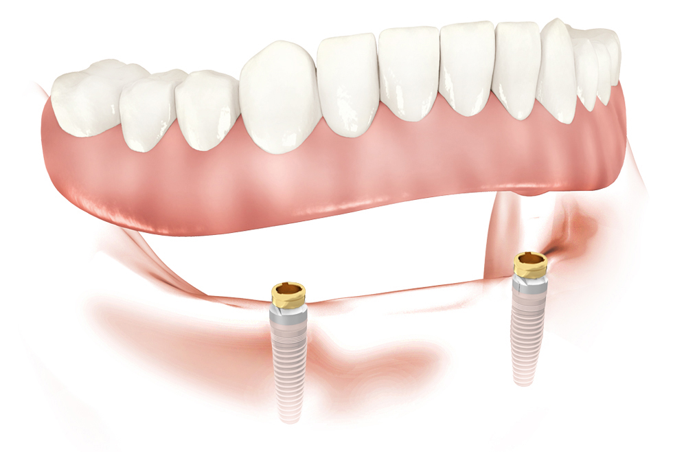 LOCATOR- AND IMPLANT-SUPPORTED COMPLETE REMOVABLE PROSTHESIS