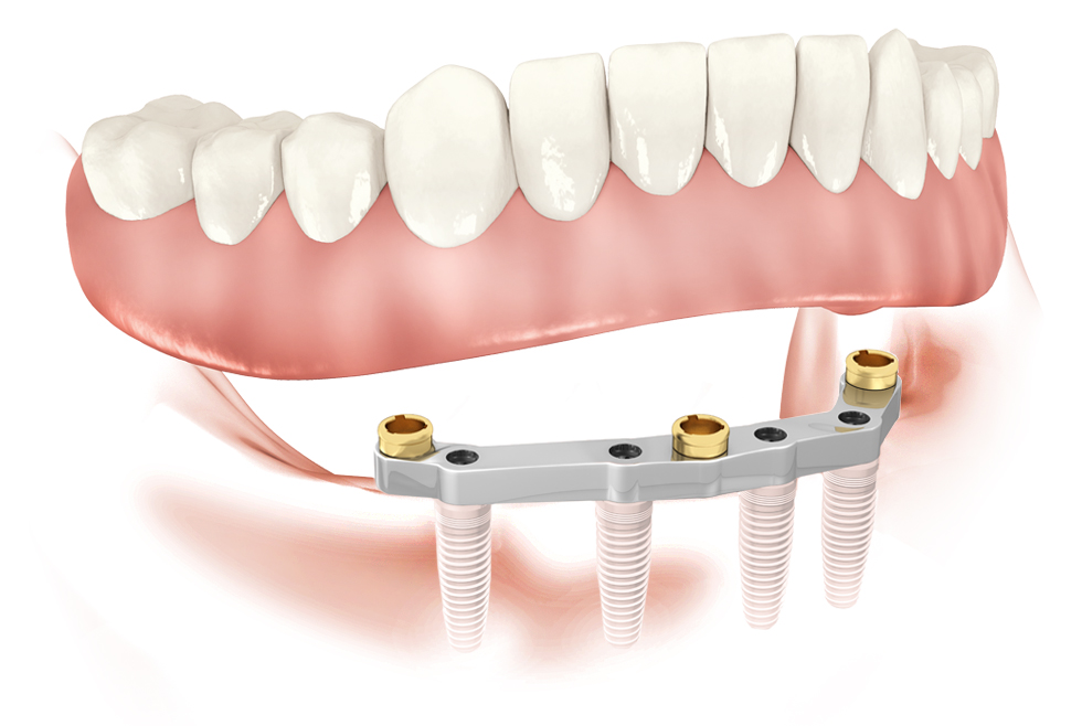 bar-retained AND IMPLANT-SUPPORTED COMPLETE REMOVABLE prosthesis