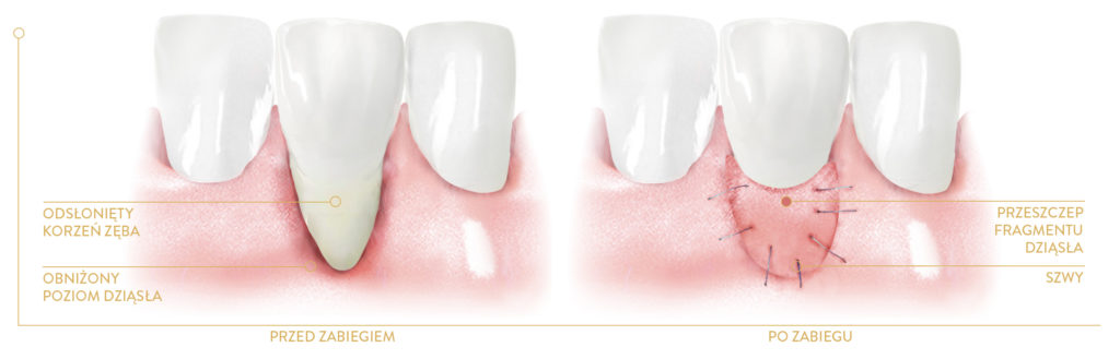 Leczenie periodontologiczne chirurgiczne - regeneracyjne