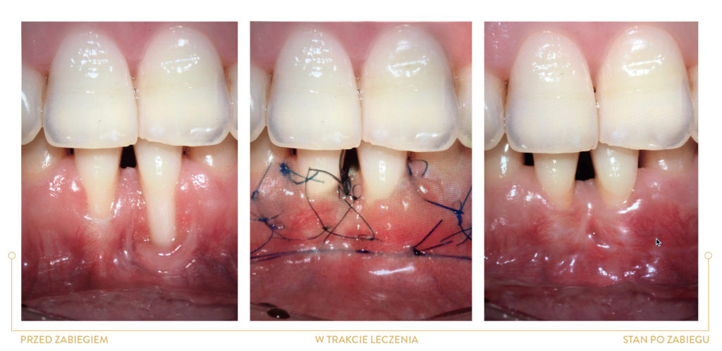 ZABIEG PŁATOWY zabiegi periodontologiczne