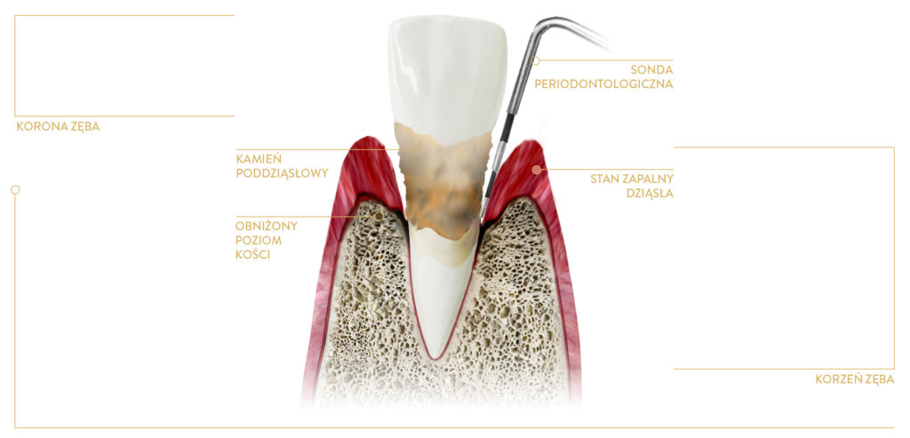 Czym zajmuje się periodontologia? ZAAWANSOWANE ZAPALENIE PRZYZĘBIA (TZW. PARADONTOZA)