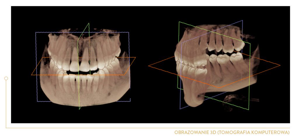 panorama zębów kraków - rtg zębów kraków - rentgen zębów kraków, ZDJĘCIA 3D TO PODSTAWA SKUTECZNEGO LECZENIA