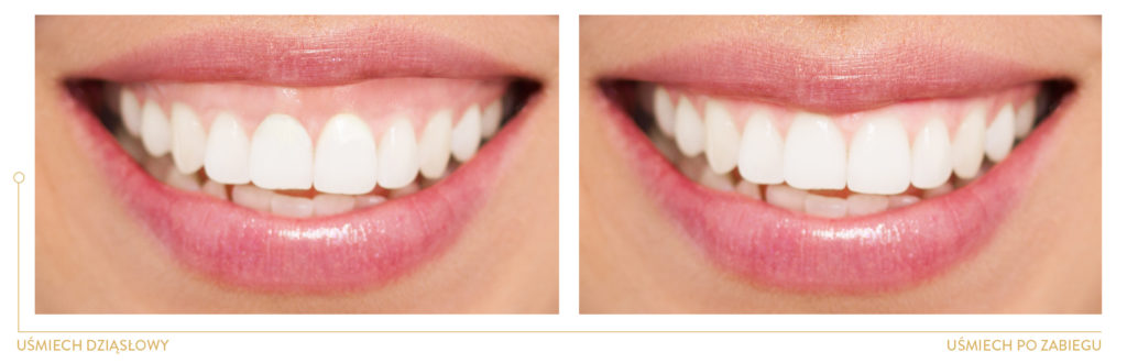 periodontologia UŚMIECH DZIĄSŁOWY PRZED I PO KOREKCIE, gummy smile
