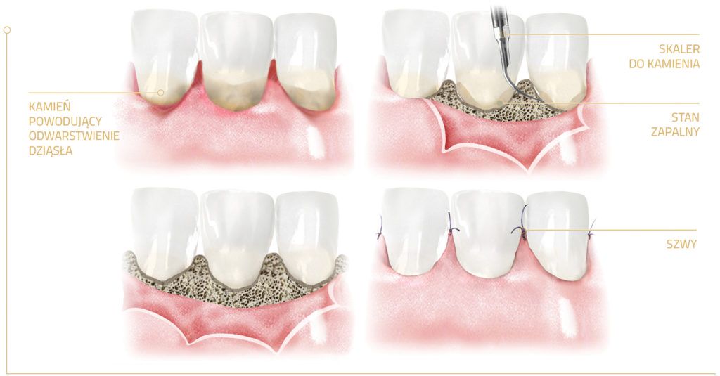 Leczenie periodontologiczne chirurgiczne - resekcyjne zabieg płatowy