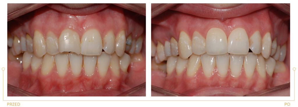 Metamorfoza III1 - estetyczna odbudowa ukruszonego zęba w wykonaniu dr Bartosza Cichonia. 