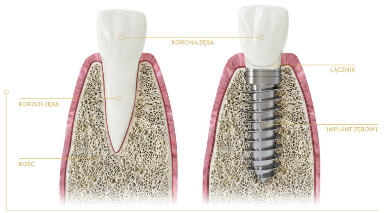 Porównanie zęba naturalnego i sztucznego implantu