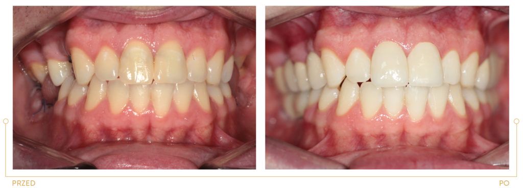 Metamorfoza II1 - pełna rehabilitacja protetyczna, uzupełnienie braków zębowych, implanty, korony pełnoceramiczne i licówki. Wybielanie. 