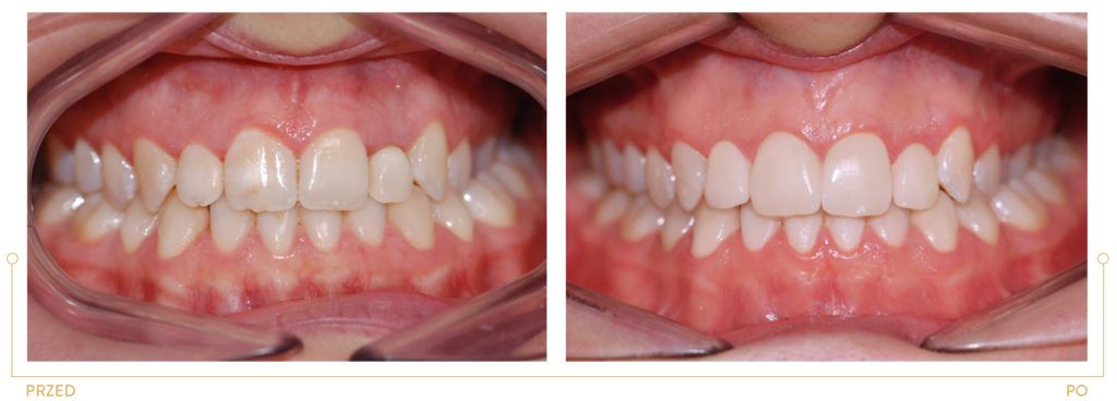 Metamorfoza 10 - korekta przebarwień i kształtu zębów siecznych z wykorzystaniem licówek
