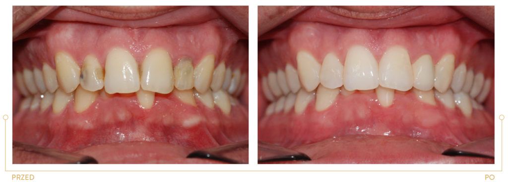 Metamorfoza 14 - korekta przebarwień i kształtu zębów, korony pełnoceramiczne