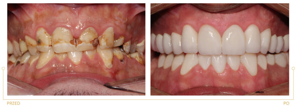 Metamorfoza 1 - leczenie endodontyczne, odbudowa protetyczna koronami pełnoceramicznymi, dr Bartosz Cichoń