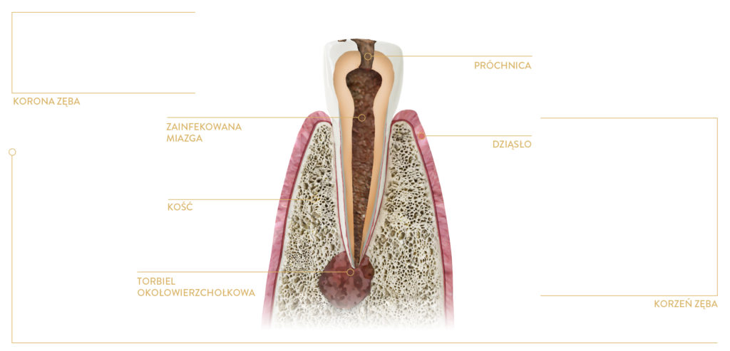 torbiel zębopochodna spowodowana infekcją miazgi zęba