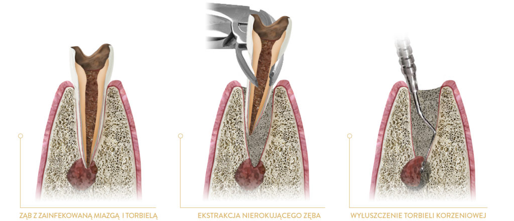 ekstrakcja zęba oraz wyłuszczenie torbieli KORZENIOWEJ