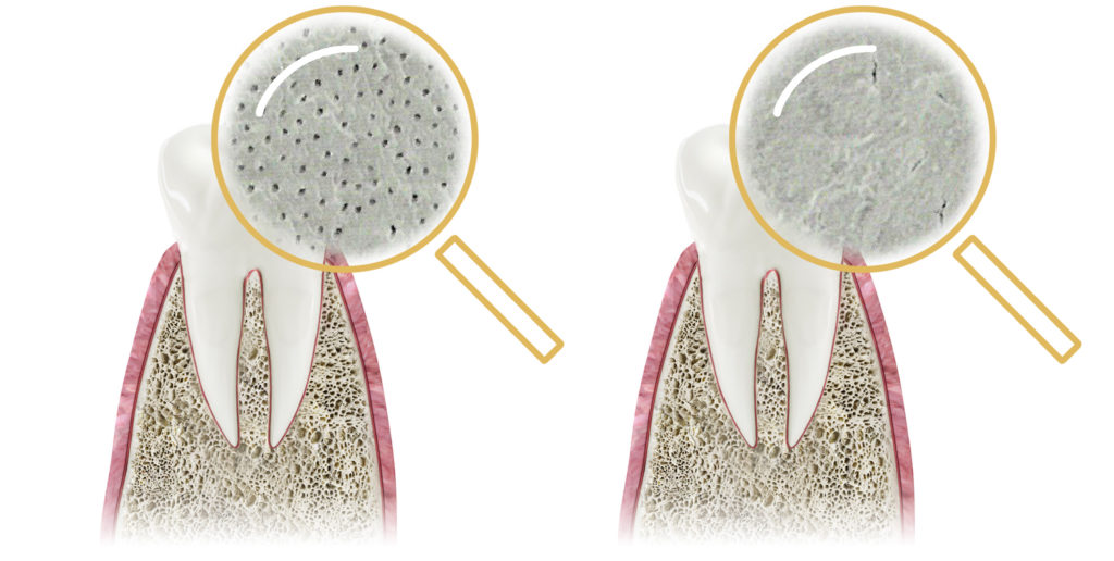 powierzchnia zęba przed zabiegiem vs powierzchnia zęba po zabiegu prevdent kraków