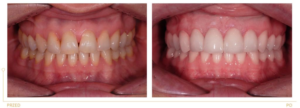Metamorfoza 17 - korekta kształtu i koloru zębów, wybielanie, licówki o podwyższonej estetyce. 