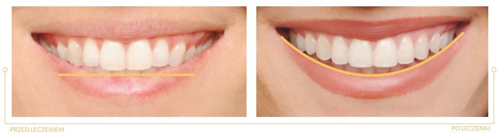 Linia uśmiechu - po leczeniu ortodontycznym, systemem samoligaturującym